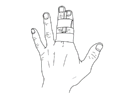 illustration showing buddy-taped fingers